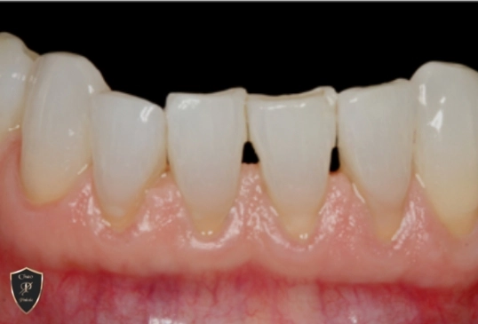 before image of a patient in need of gum surgery