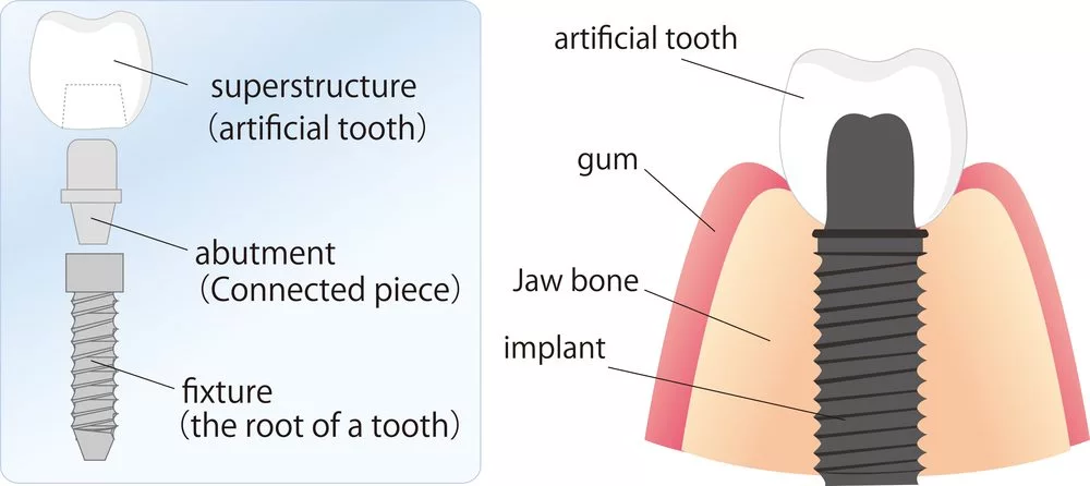 diagram of dental implants and how they fit into the jaw