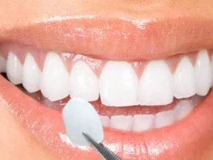 Close-up of how a dental veneer is applied to a tooth.