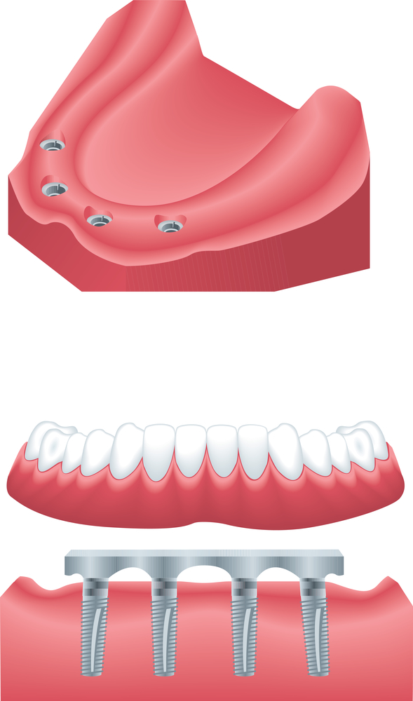 diagram of all-on-4 dental implants