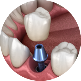 dental implant being placed at Pankaj Narkhede, DDS