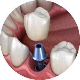 dental implant being placed at Pankaj Narkhede, DDS