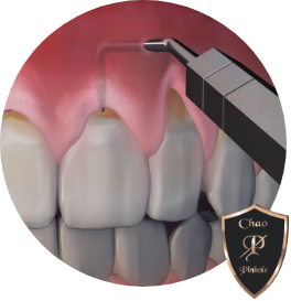 example of Chao pinhole gum surgery