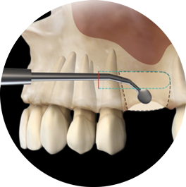 model of S.M.A.R.T. bone grafting