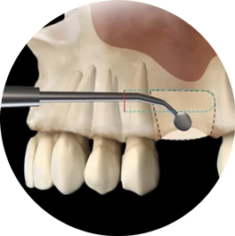 model of S.M.A.R.T. bone grafting