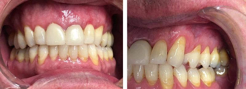 before look at a patient's mouth with receding gums