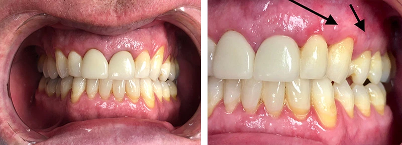 after look of a patient's mouth where their gums have been restored thanks to pinhole gum surgery from Pankaj Narkhede, DDS